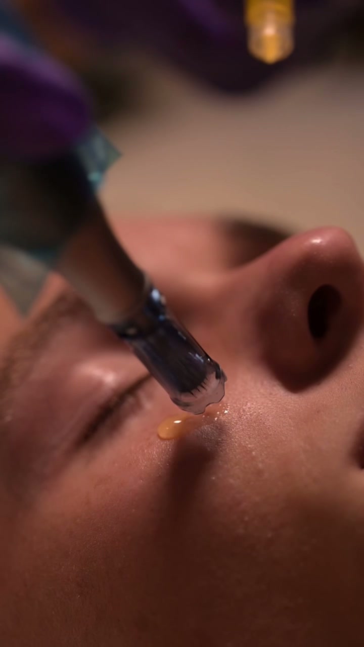 Mesotherapy — mesotherapy Miami