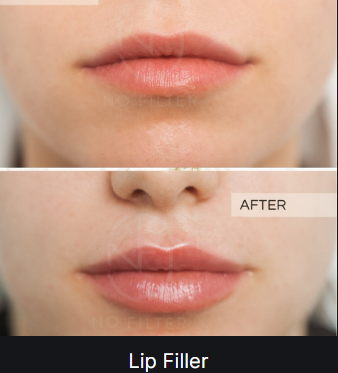 Lip Filler — before and after (placeholder)