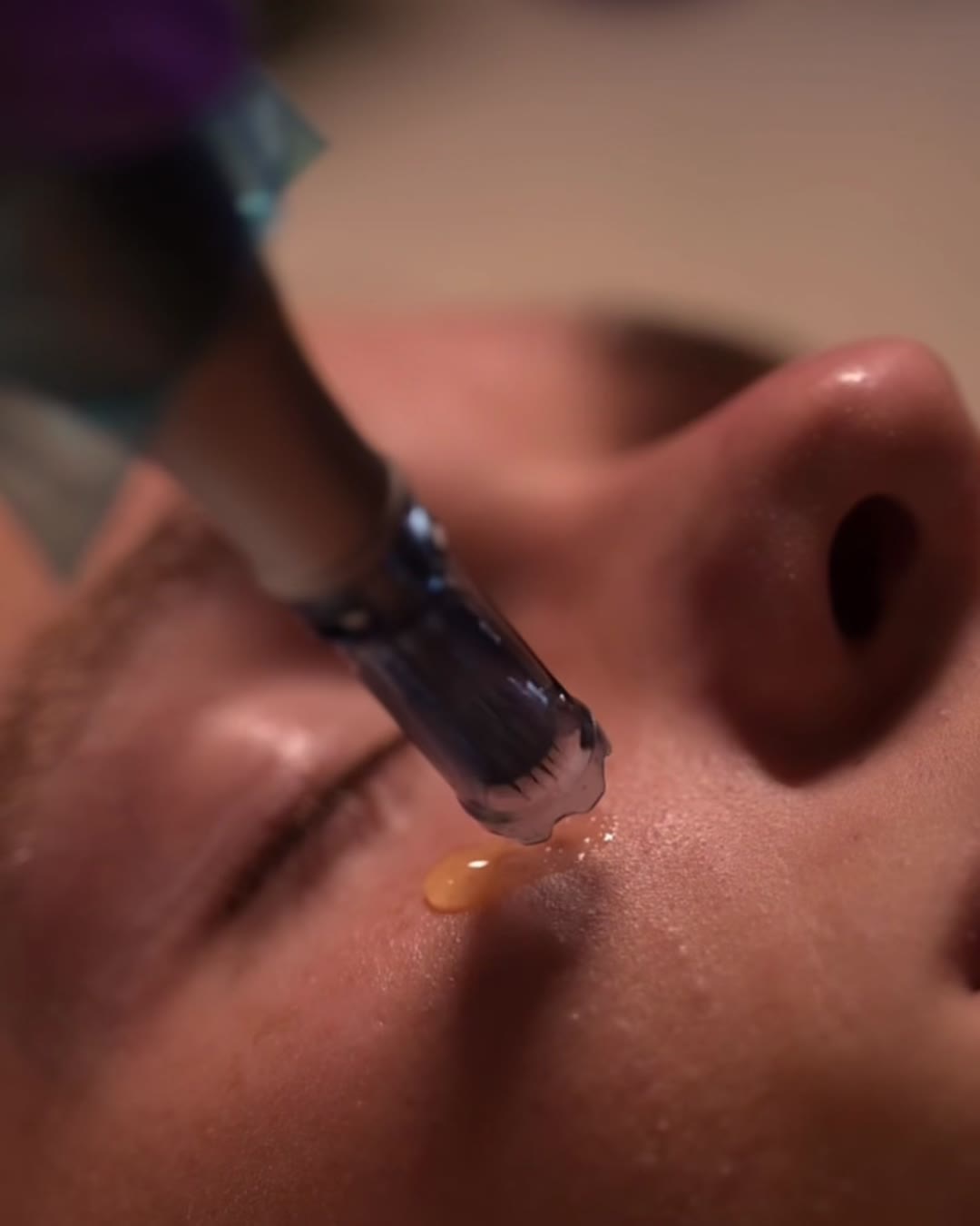Mesotherapy facial in Brickell, Miami