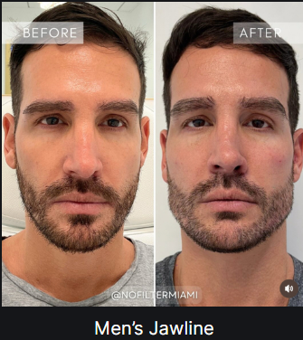 Men's Jawline — before and after (placeholder)