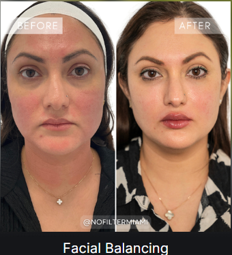 Facial Balancing — before and after (placeholder)