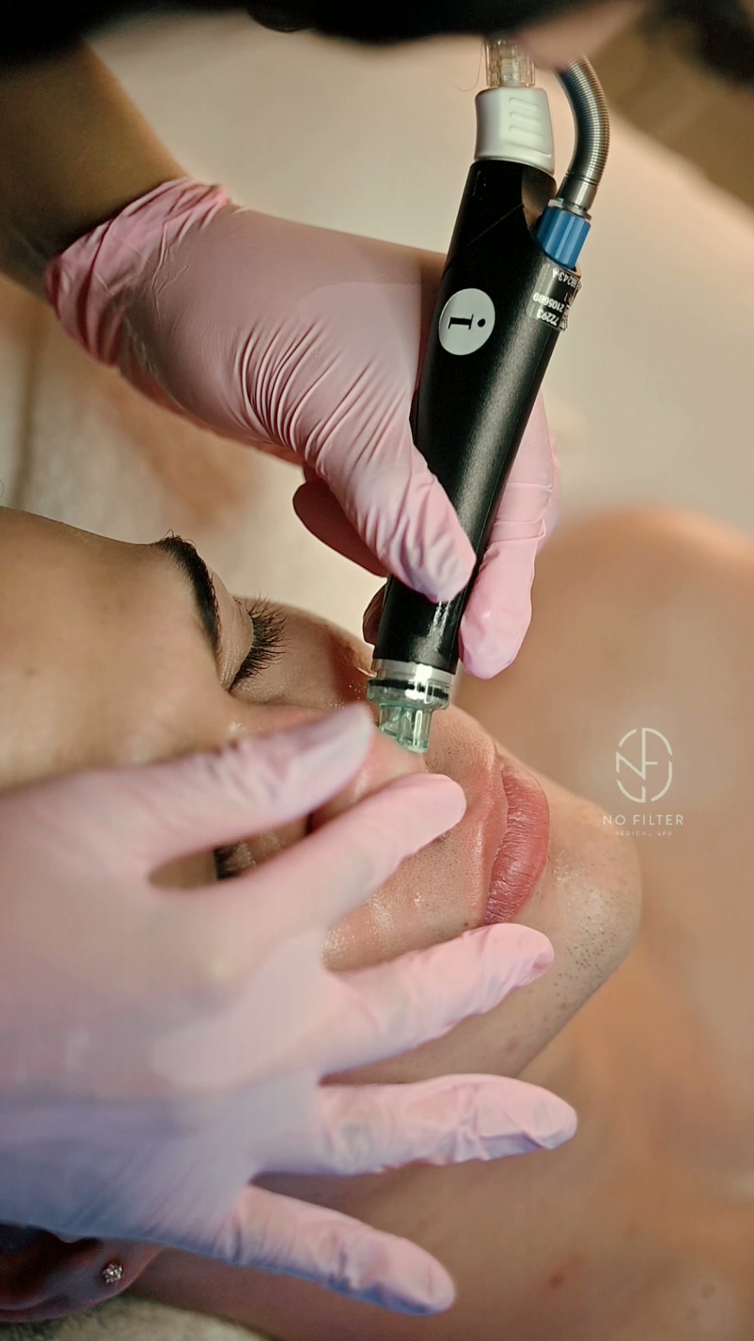 Microneedling — microneedling Miami