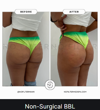 Non-Surgical BBL — before and after (placeholder)