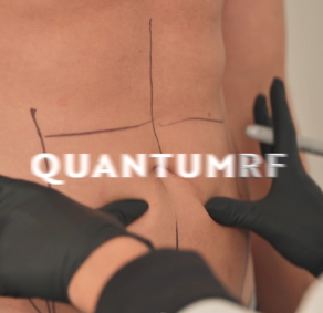 Quantum RF skin tightening treatment at No Filter Medical Spa in Brickell, Miami
