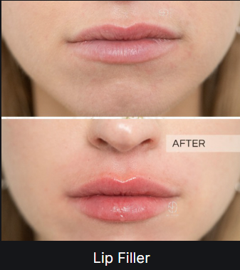 Lip Filler — before and after (placeholder)