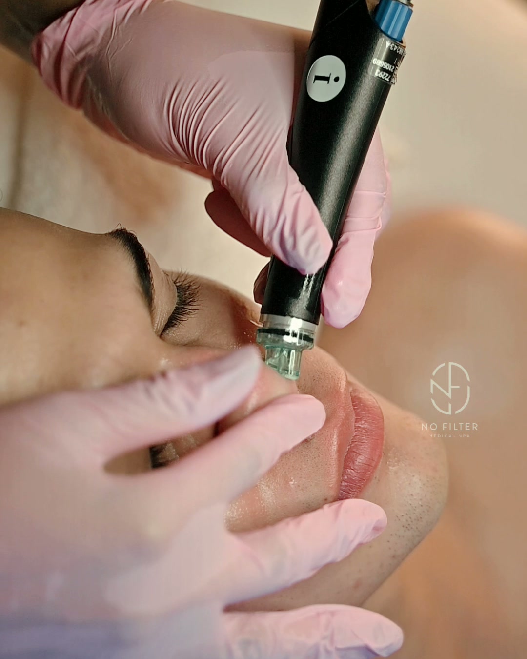 Microneedling treatment in Brickell, Miami