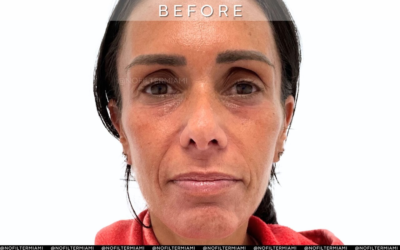 No Filter Medical Spa patient result, before treatment