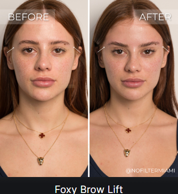 Foxy Brow Lift — before and after (placeholder)