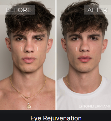 Eye Rejuvenation — before and after (placeholder)