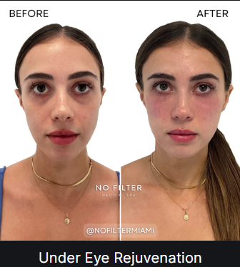Under Eye Rejuvenation — before and after (placeholder)