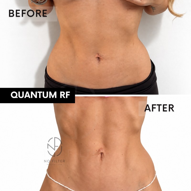 Quantum RF Body result — Quantum RF, abdomen